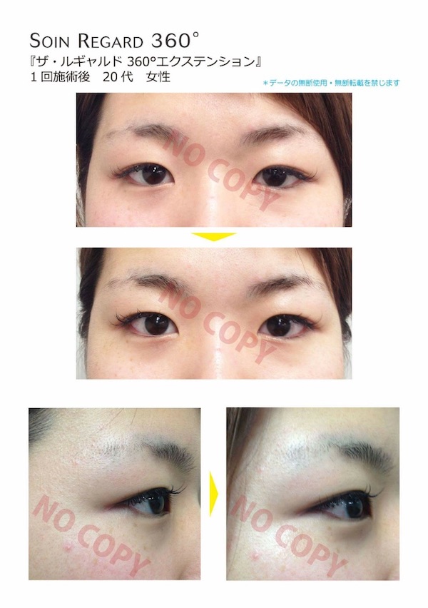 No.21 アイトリートメント　施術前、背術後